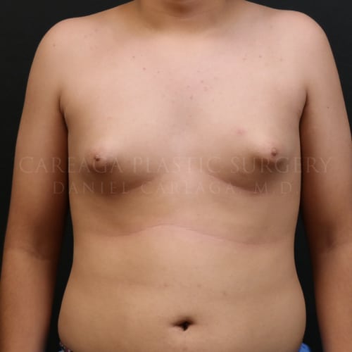 Gynecomastia Case 6060 before