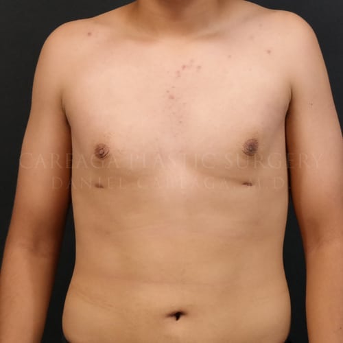 Gynecomastia Case 6060 after