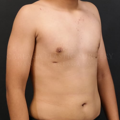 Gynecomastia Case 6060 after, view 2