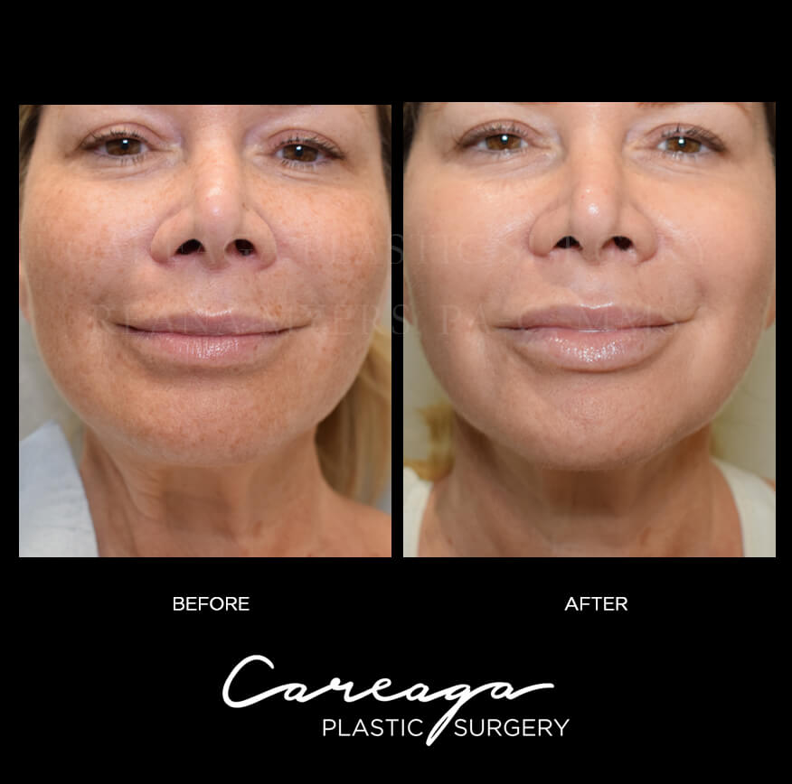 Is IPL Treatment Safe and Permanent 