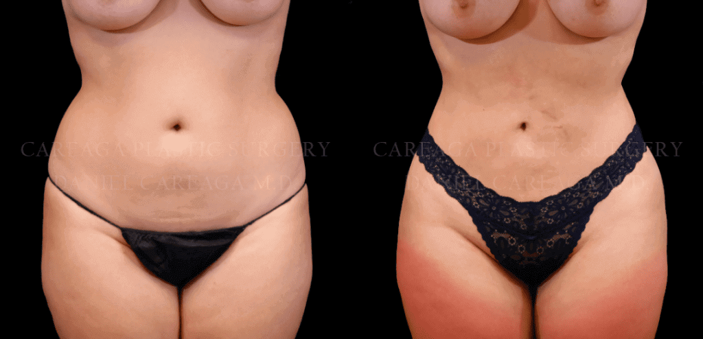 4 Things to Expect With Liposuction