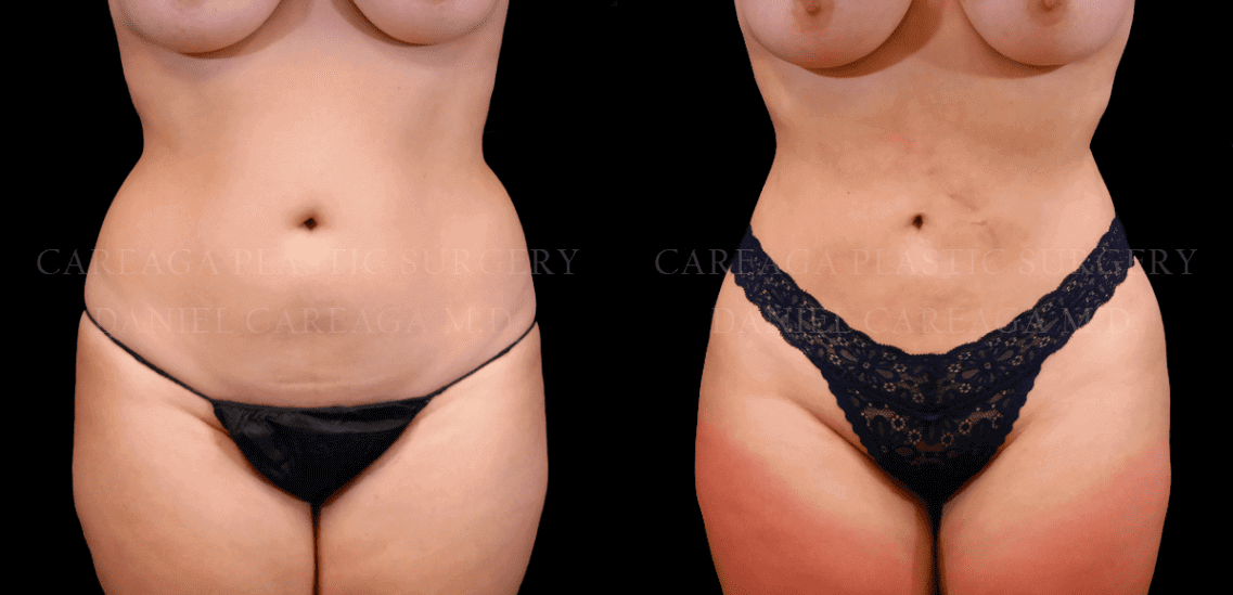 Your Laser Liposuction Recovery Guide