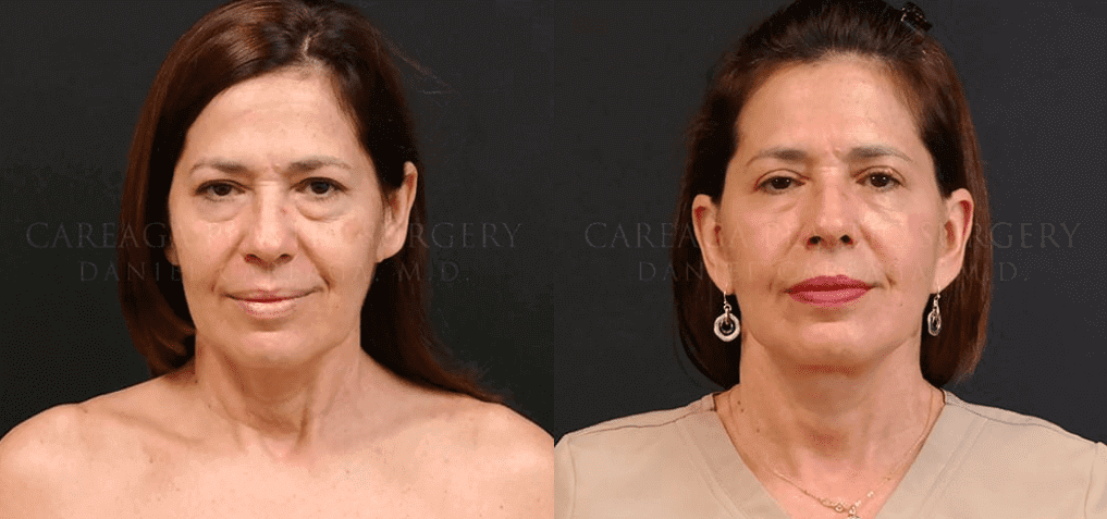 facelift-after-2-img-blog