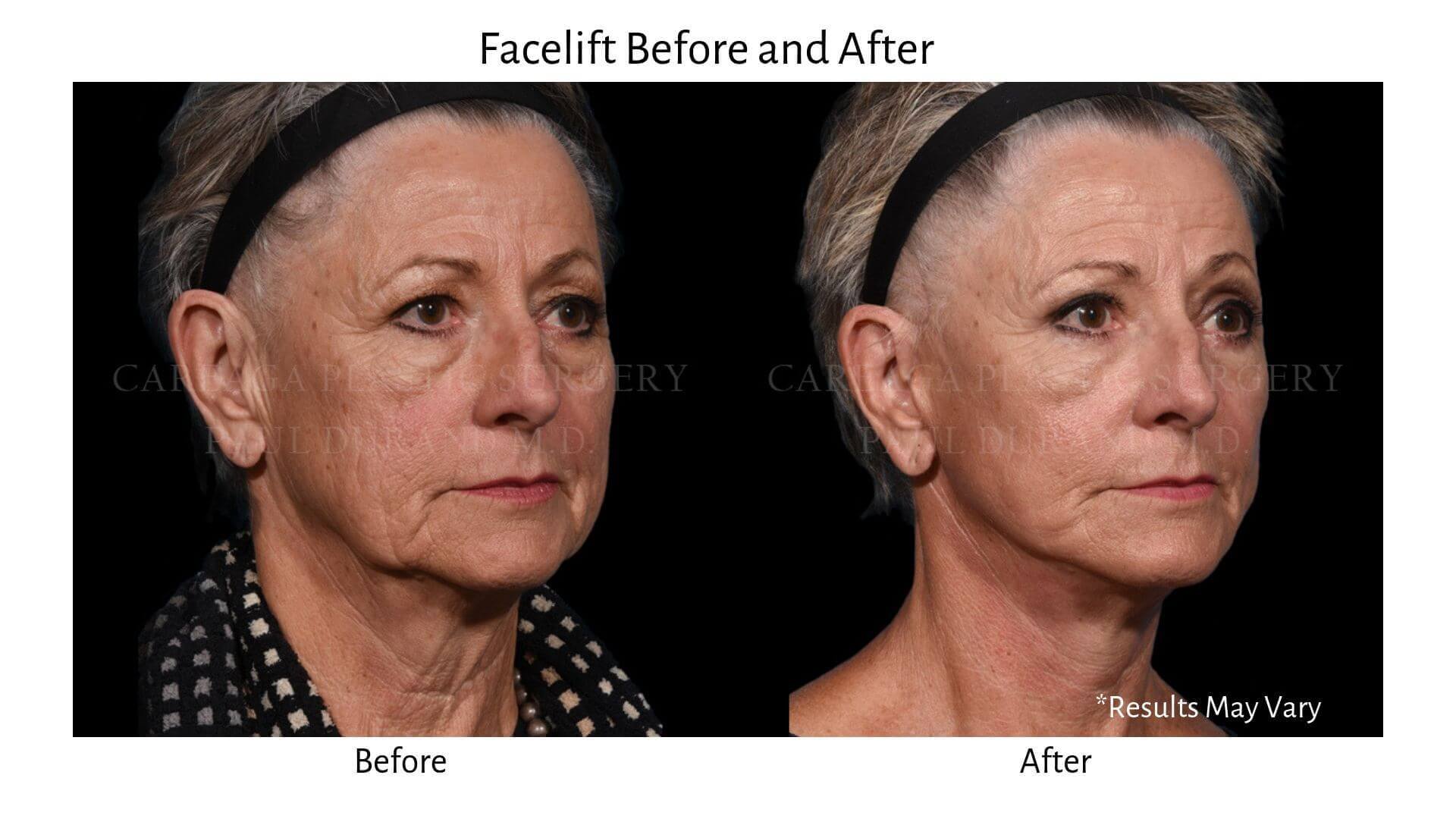 img-blog-facelift-BA