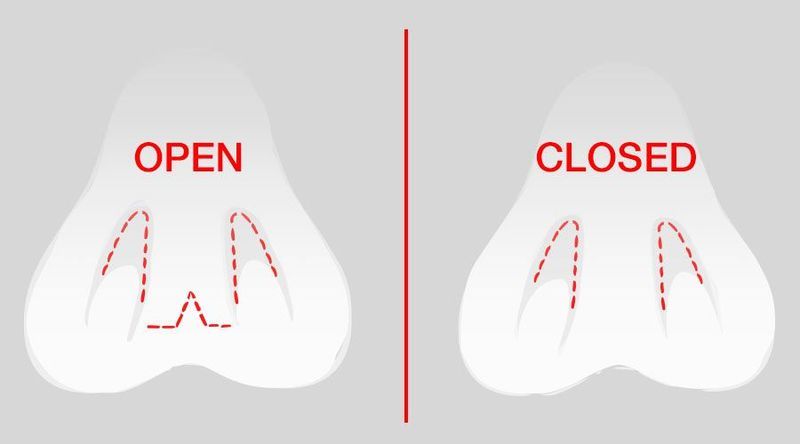 open and closed nasal incisions-img-blog