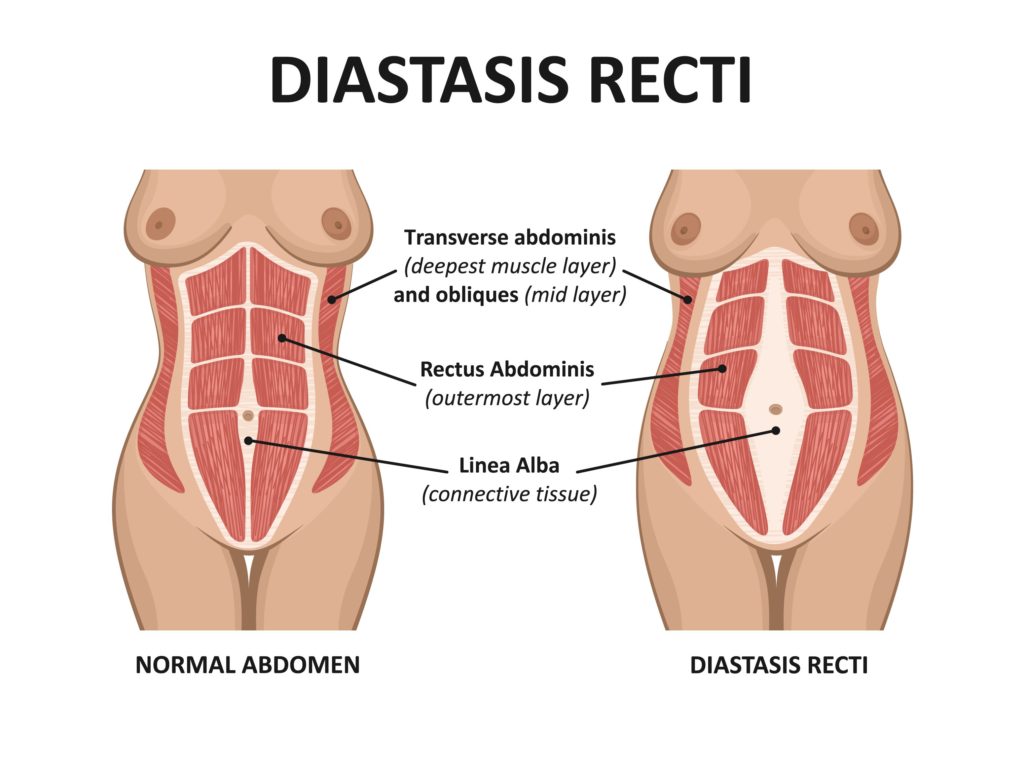 Diastasis recti. Abdominal muscle diastasis after pregnancy pregnancy and childbirth