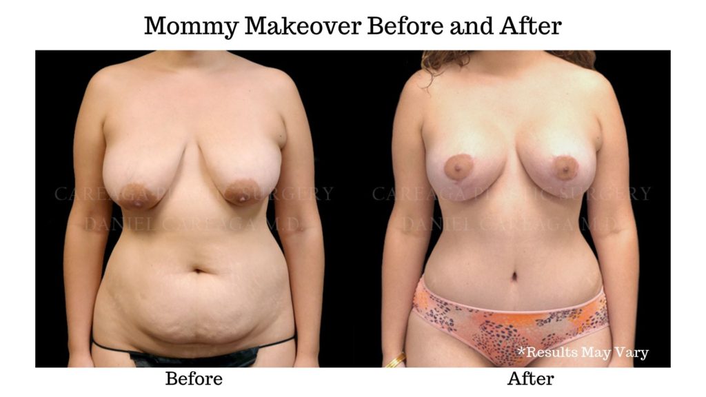 Dr. Careaga Mommy Makeover Patient before and after photos