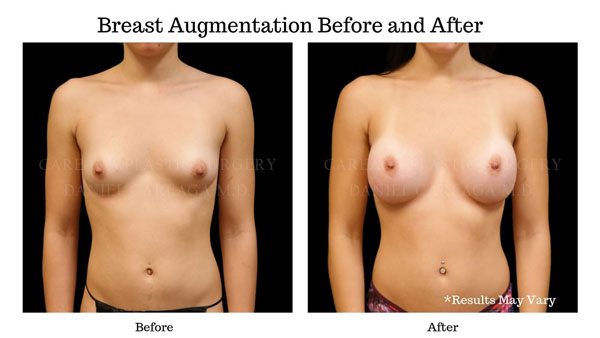 Before and after for a breast augmentation performed in Coral Gables, Florida.