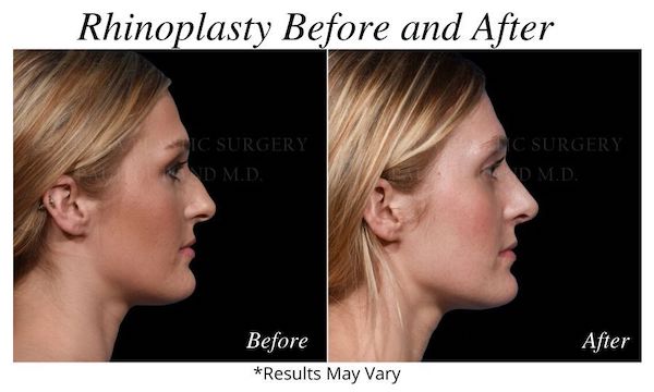 Before and after image showing the results of a rhinoplasty performed by Dr. Durand in Miami, FL.