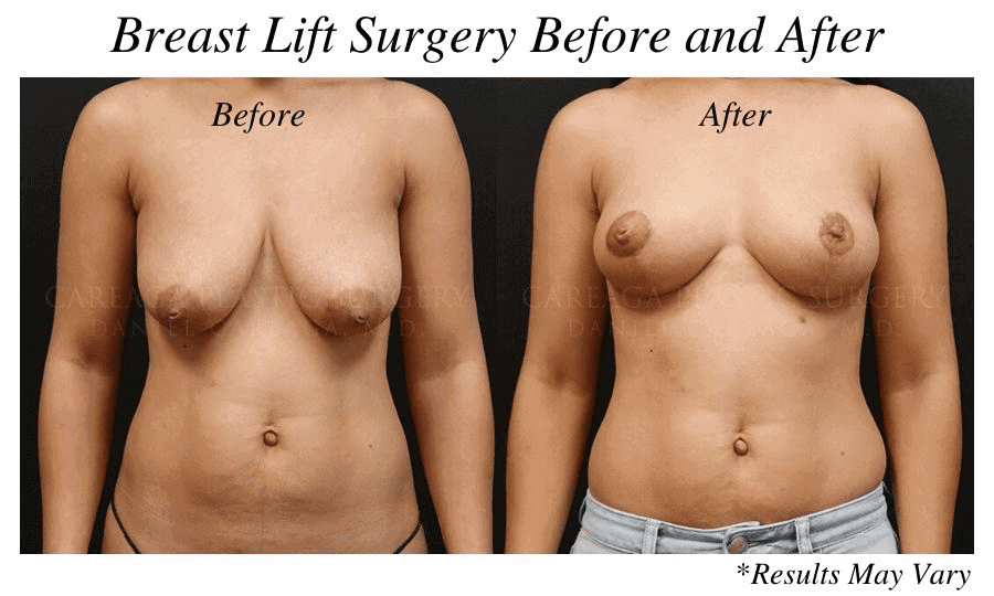 Breast lift before and after showing results achieved by Dr. Careaga in Miami, Florida.