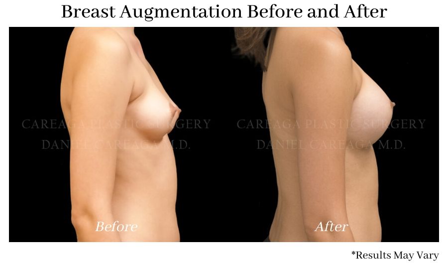 Before and after image showing the results of a breast augmentation performed in Coral Gables, FL.