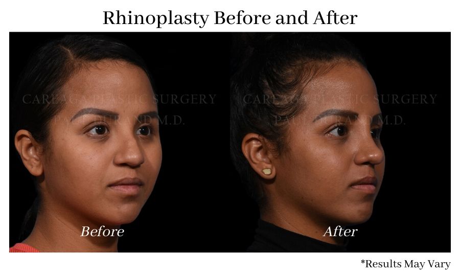 Before and after image showing the results of a rhinoplasty in Coral Gables, FL.