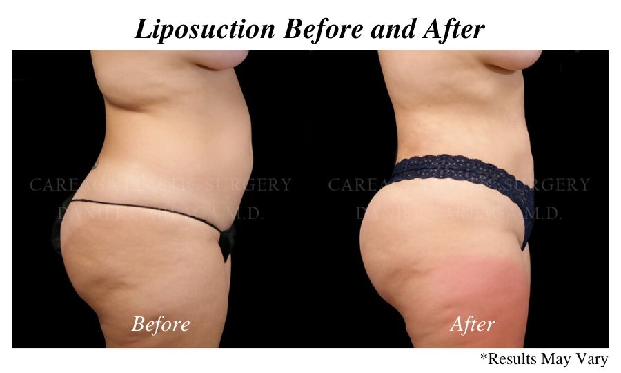 Before and after image showing the results of liposuction on the abdomen, back, and flanks in Miami.