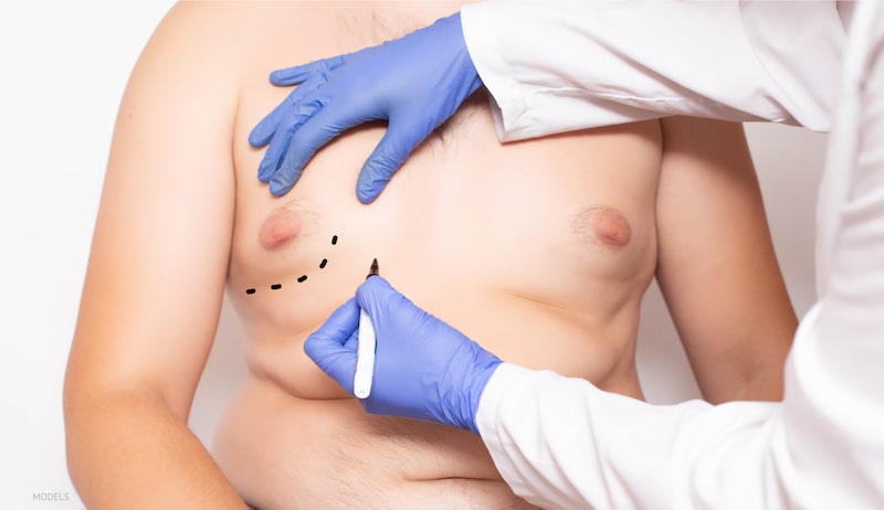 Do Men Have to Worry About Gynecomastia Scars?
