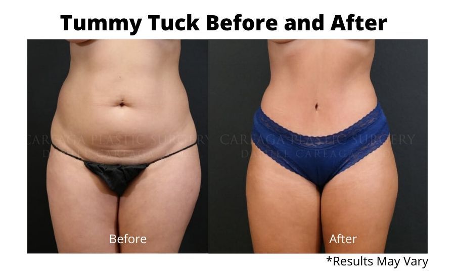 Tummy tuck before and after