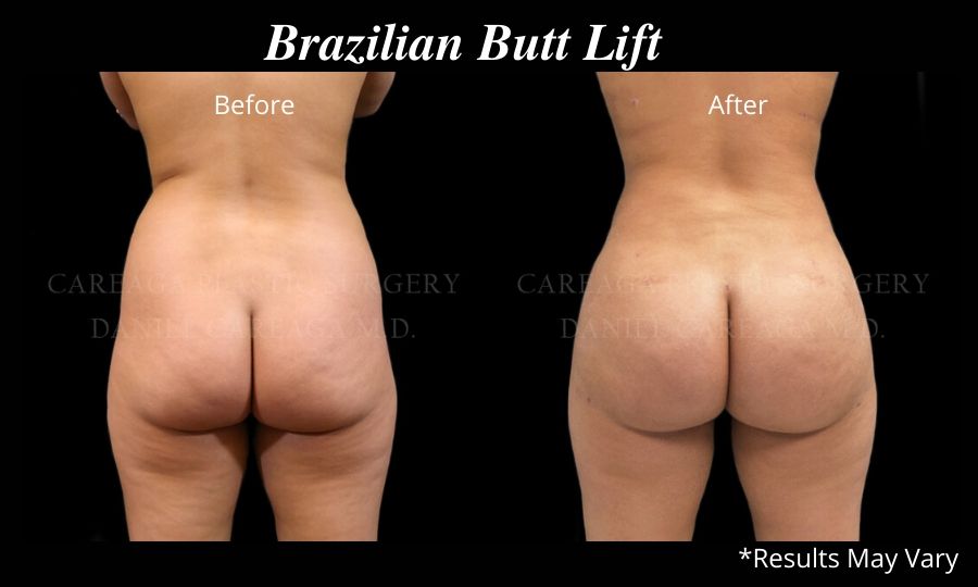 Before and after image of a Brazilian Butt Lift performed in Miami. Dr. Careaga transferred fat from the abdomen, back, and flanks.