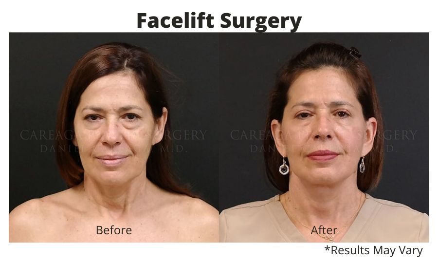 Before and after image showing the results of a facelift performed at Careaga Plastic Surgery