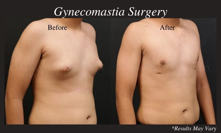 Before and after image showing the results of a gynecomastia surgery.