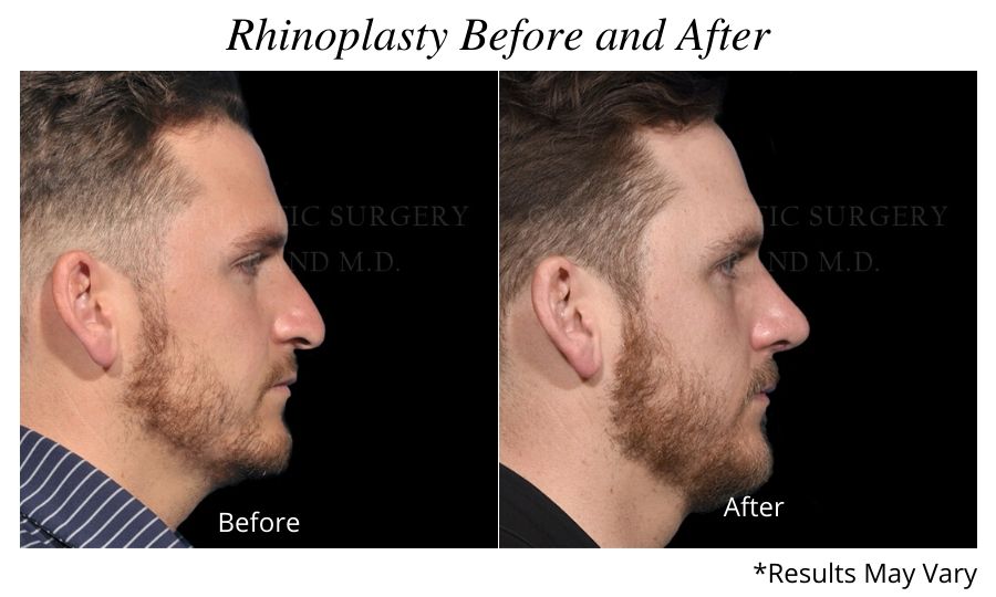 Before and after image showing the results of a rhinoplasty in Miami, FL.