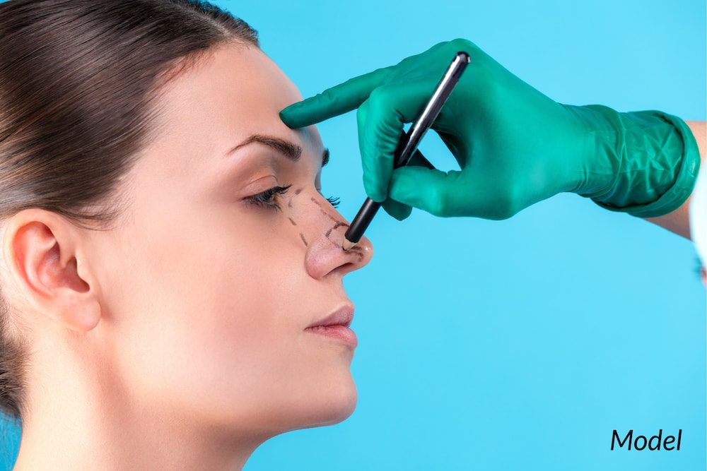 Woman with lines drawn on nose before rhinoplasty.