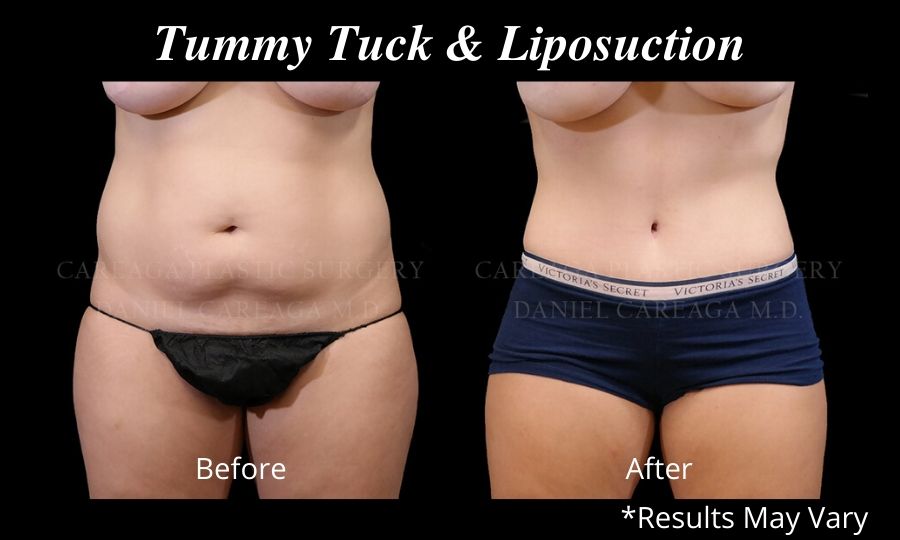 Before and after image showing the results of a tummy tuck and liposuction of the flanks performed in Miami.