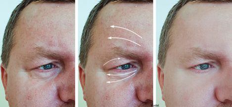 Before and after image of a man before a wrinkle-reduction treatment.