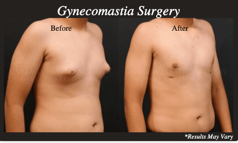 Results of male breast reduction