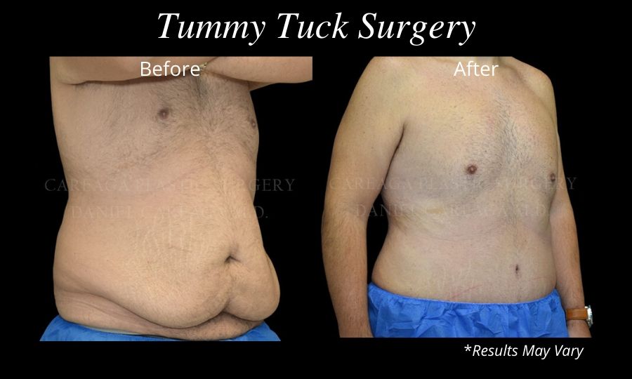 Tummy Tuck before and after results