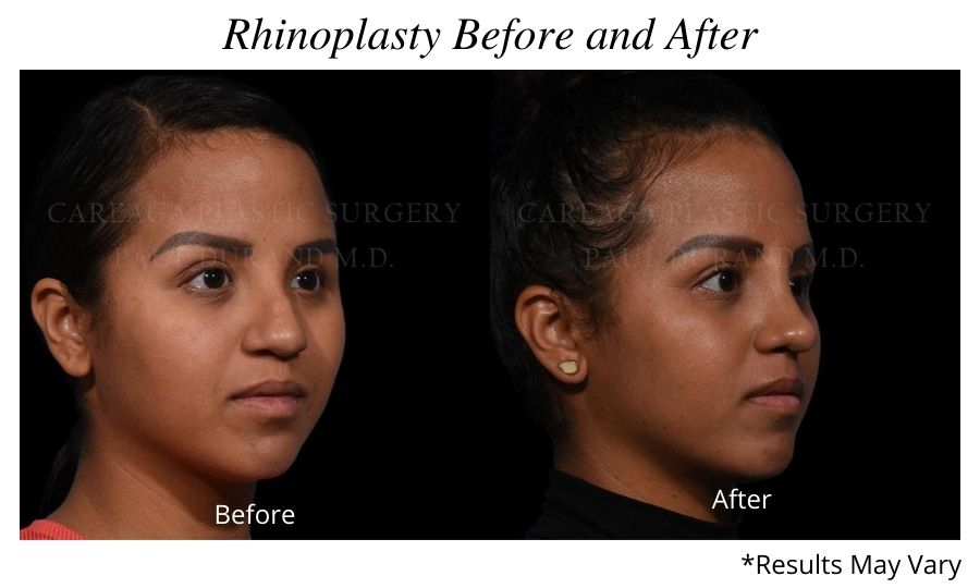 Before and after image showing the results of a rhinoplasty performed in Miami.
