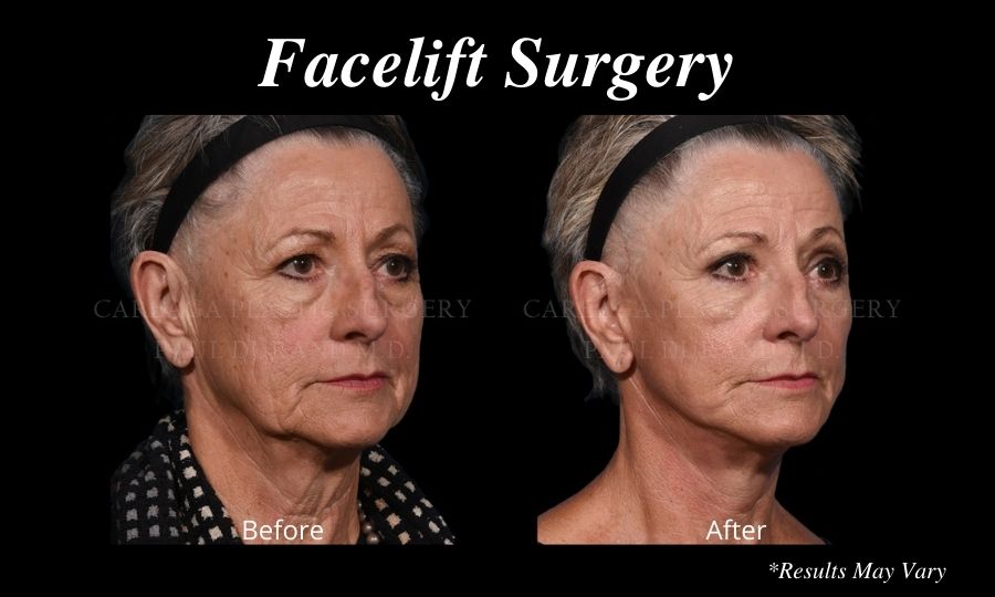 Before and after image showing the results of a facelift surgery performed in Miami, FL.