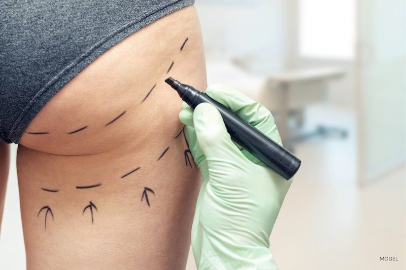 plastic surgeon marking woman's buttocks for Brazilian Butt Lift surgery