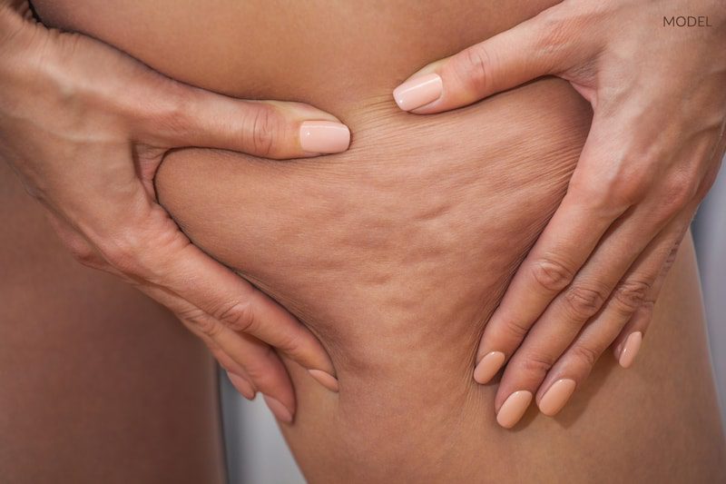 Is There a Plastic Surgery Solution for Cellulite?