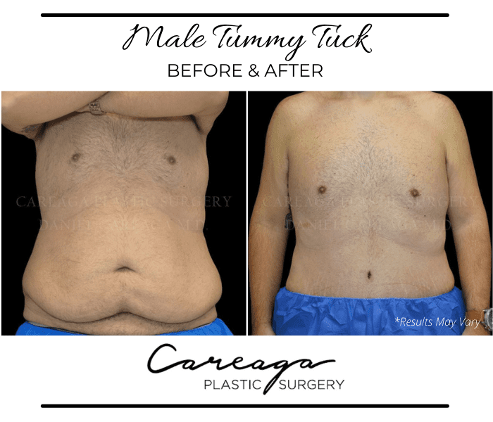 Before and after image showing the results of a tummy tuck performed in Miami, FL.