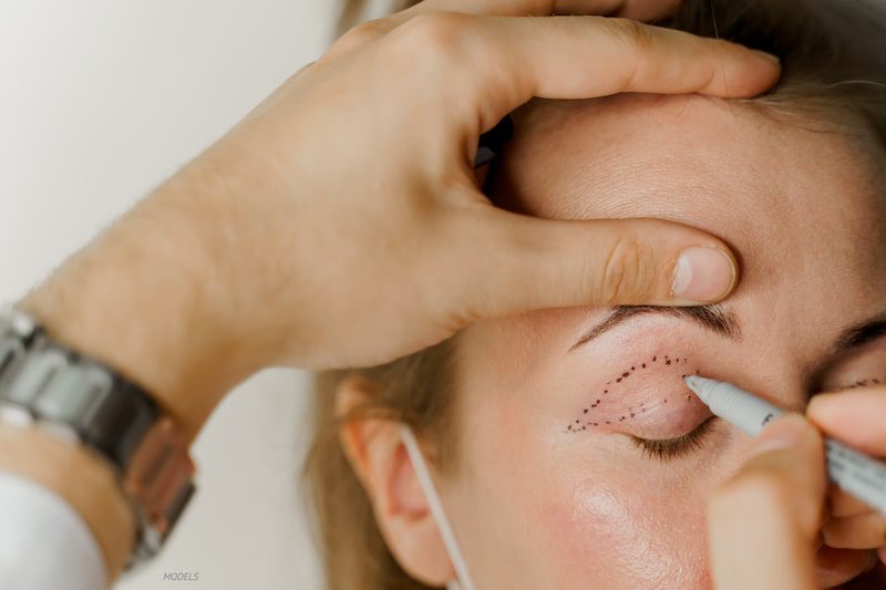 Woman undergoing a consultation for blepharoplasty with lines drawn on eyelid.