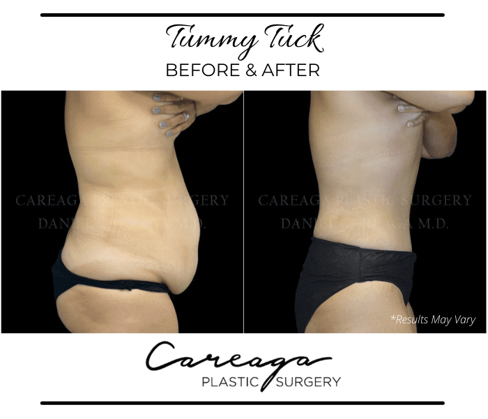 Before and after image showing the results of a tummy tuck performed in Miami, FL.