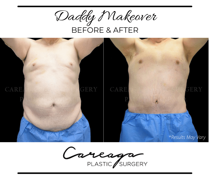 Before and after image showing the results of a Daddy Makeover performed in Miami, FL.