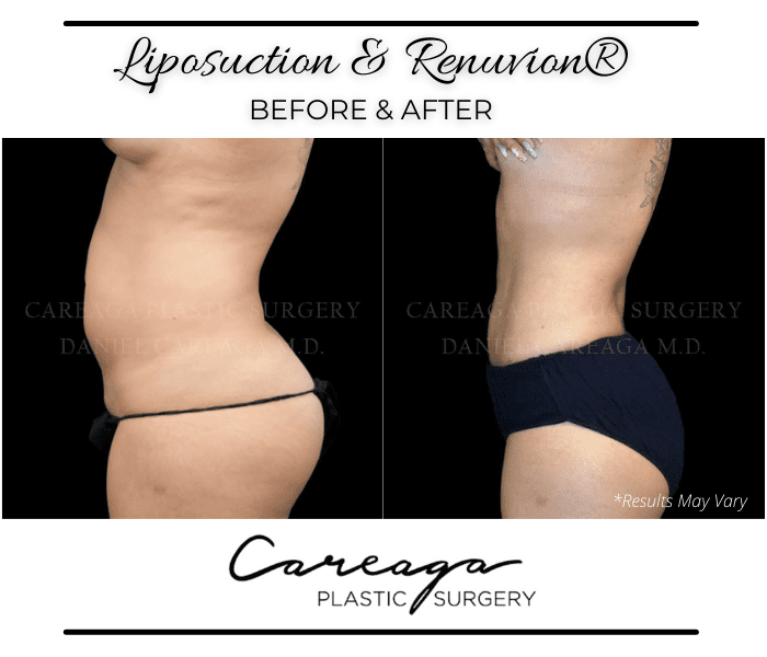 Before and after image showing the results of a liposuction treatment performed in Miami, FL.