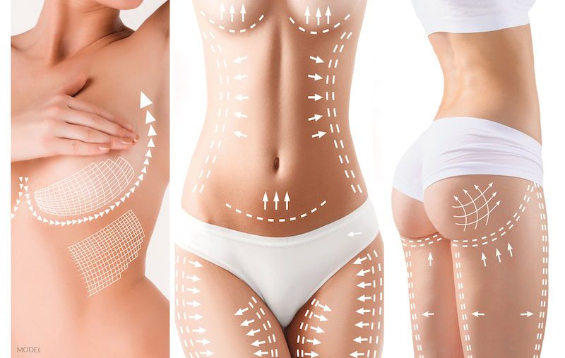 Three images of a woman with.a focus on the breasts, midsection, and buttocks and legs with arrows to mark cosmetic improvement