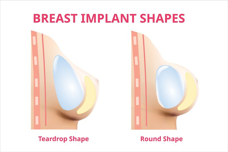 Illustration comparing breast implant shapes - round and teardrop.