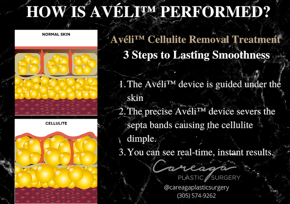 Infographic showing how Aveli works. 