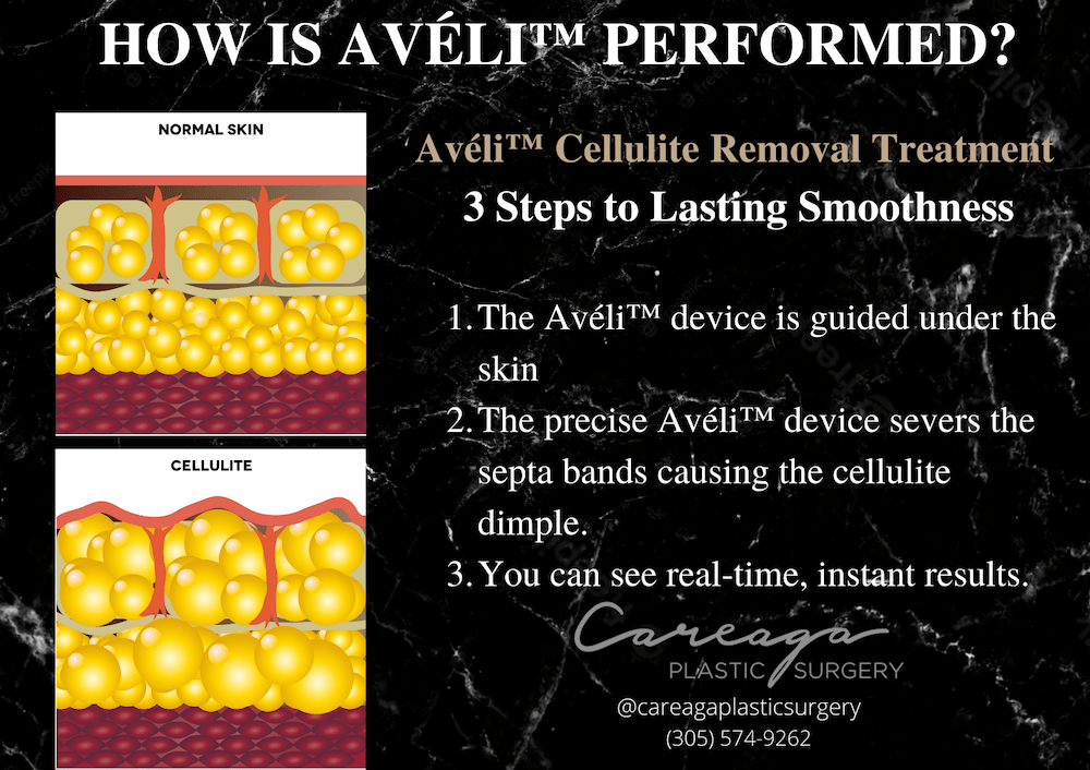 Infographic showing how Aveli works.
