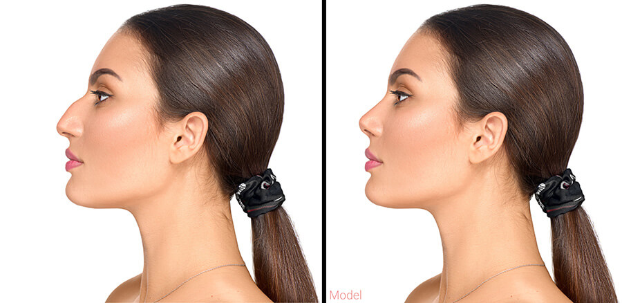 Profile photos of a woman simulating before and after a rhinoplasty.