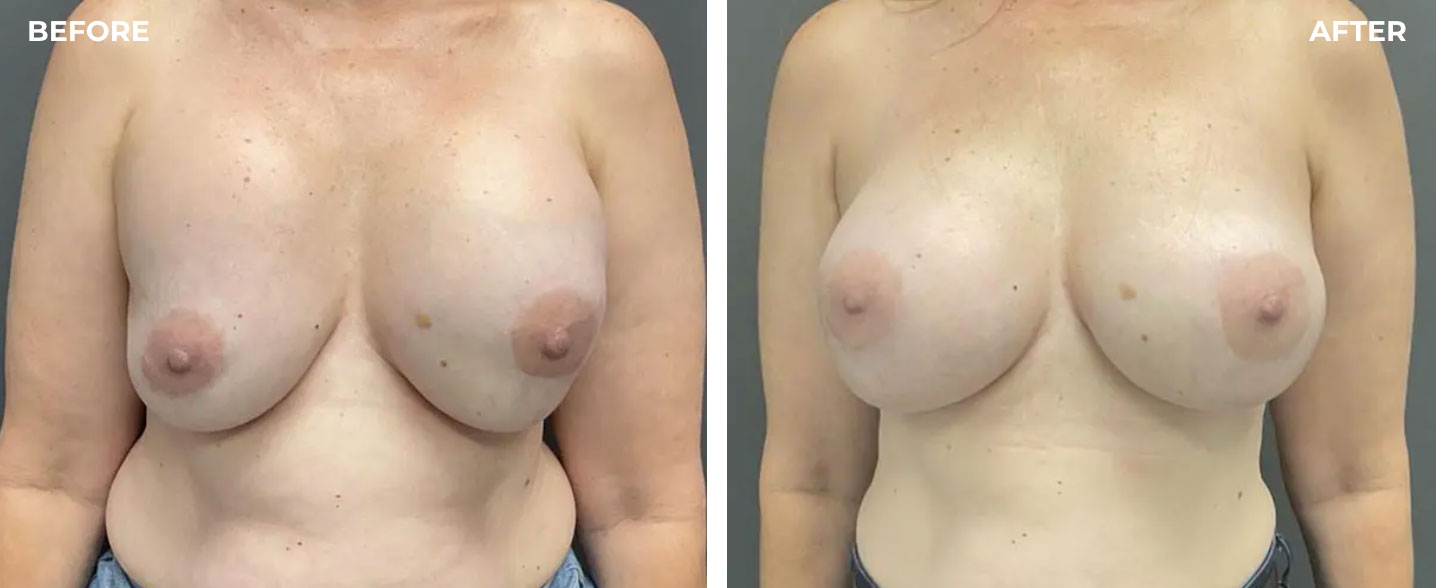 Breast Implant Replacement Before & After