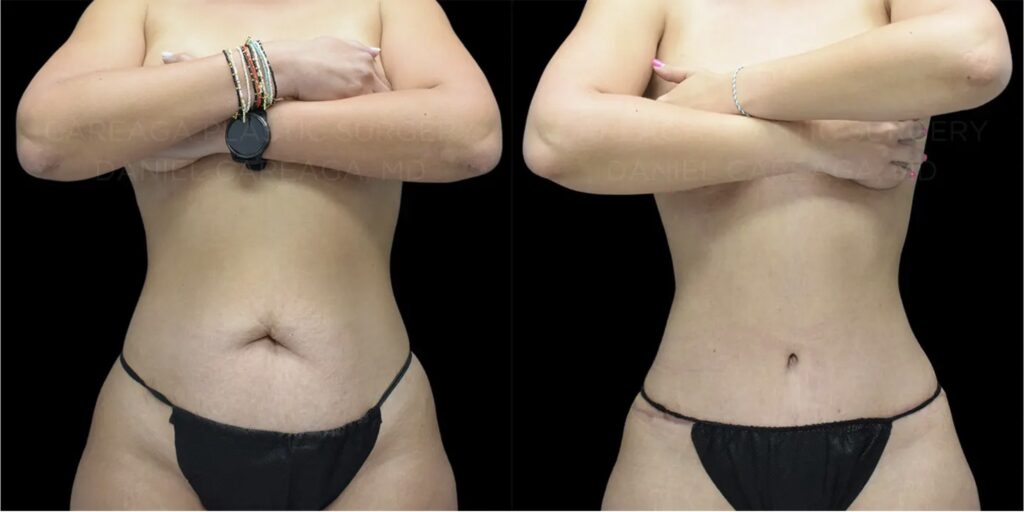 pre and post op tummy tuck abdominoplasty miami florida careaga plastic surgery
