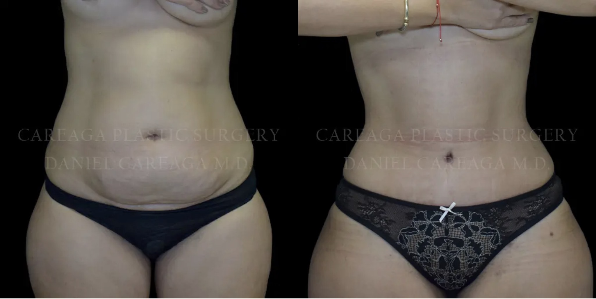Before and After Tummy Tuck Abdominoplasty Miami Florida