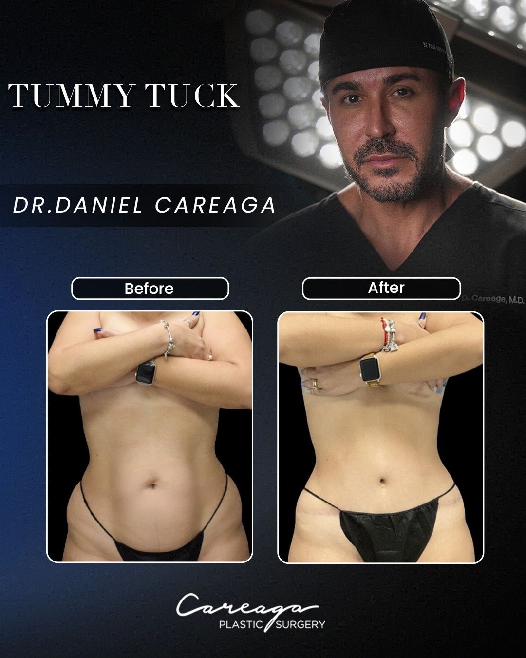 Before and After Tummy Tuck Abdominoplasty Miami Florida Careaga Plastic Surgery
