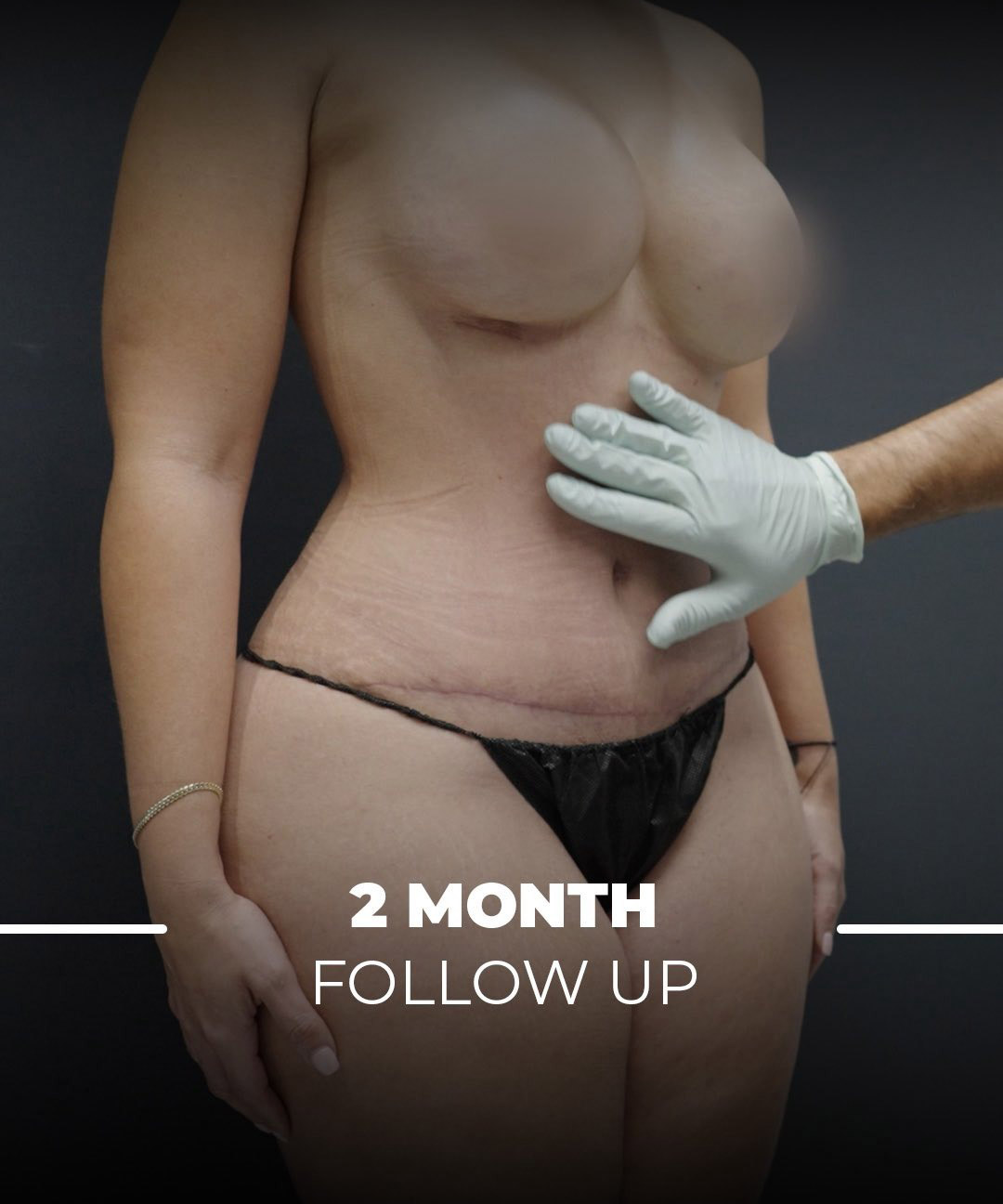 2 months follow up on a Tummy Tuck