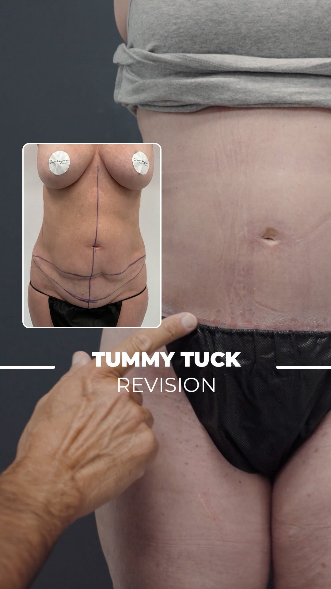 Dr. Careaga illustrating a Tummy Tuck Revision