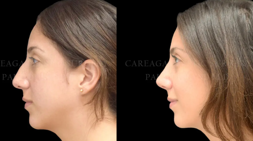 Actual patient rhinoplasty results