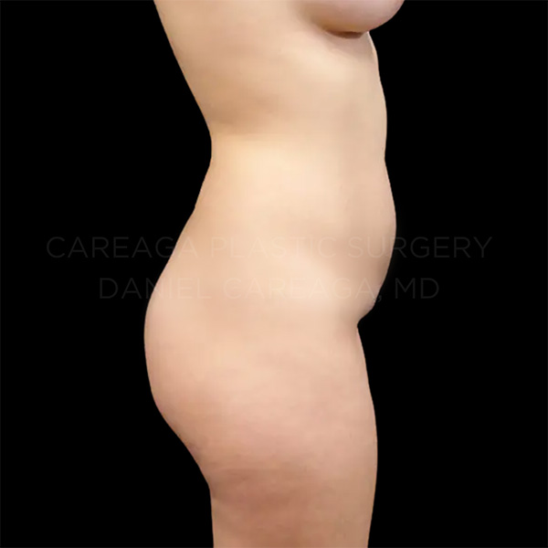 Brazilian-Butt-Lift-Case--013owb | Before Brazilian Butt Lift